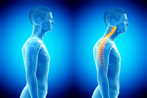 Posture and Headaches: What is the Link?
